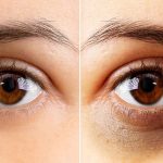 Home remedies to get rid of dark circles