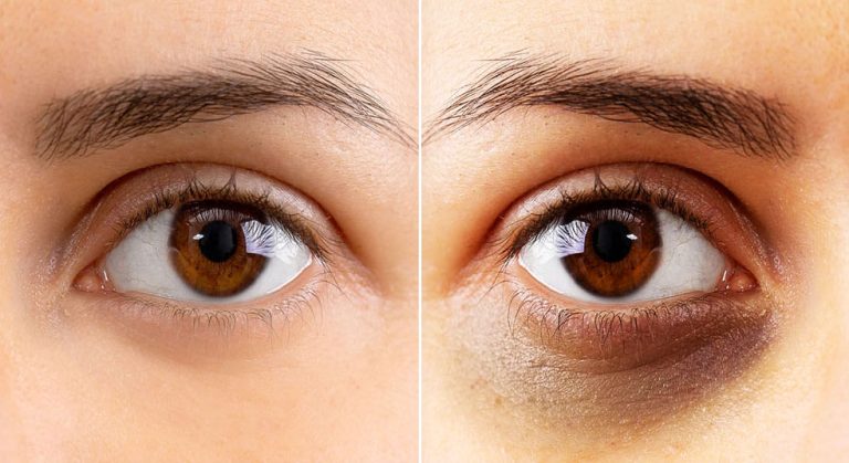 Home remedies to get rid of dark circles