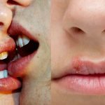 Kissing also causes disease, know what is 'kissing disease'