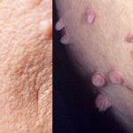 Painless way to get rid of skin tags