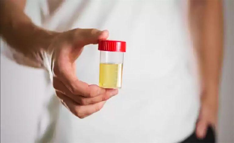 Color of urine changed ?, it can be a sign of this serious disease!