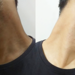 how to get rid of black neck