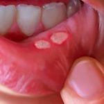 Mouth Ulcers-Causes, symptoms, and Treatments - The Monk