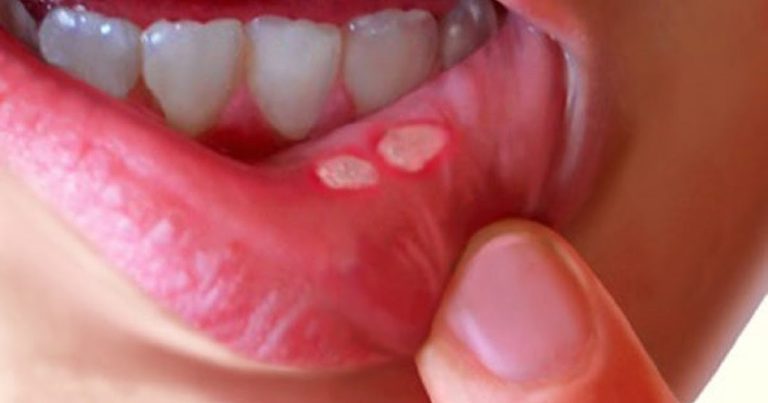 Mouth Ulcers-Causes, symptoms, and Treatments