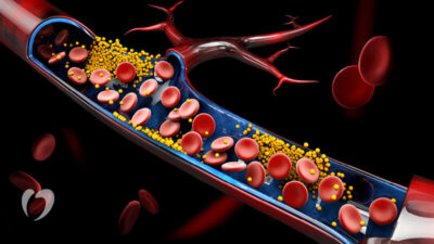 Unhealthy eating habits that raise bad cholesterol levels