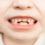 Cavities : Prevention, Common Causes of Tooth Decay in Children