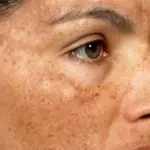 Hyperpigmentation: Natural Remedies for Even-Toned Skin