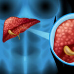 Liver Cancer