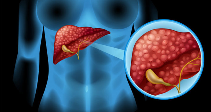 Liver Cancer: Can sugar and obesity cause liver cancer?