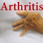 Arthritis Problem is more common in women, some changes in lifestyle can prevent it