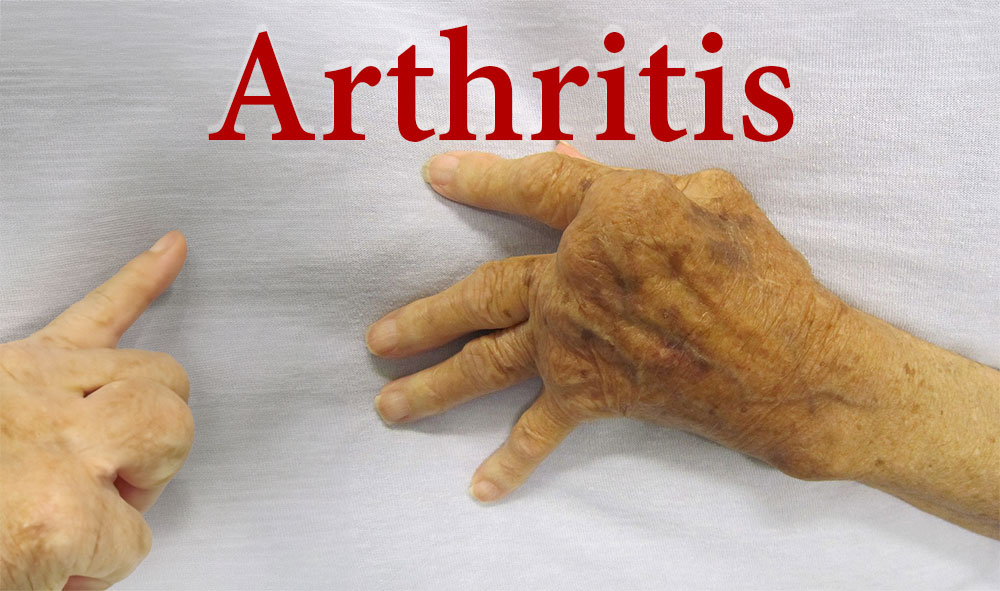 Arthritis Problem is more common in women, some changes in lifestyle can prevent it