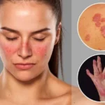 Symptoms of Lupus