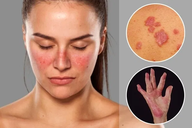 Symptoms of Lupus: If such rashes are visible on the body, then be careful